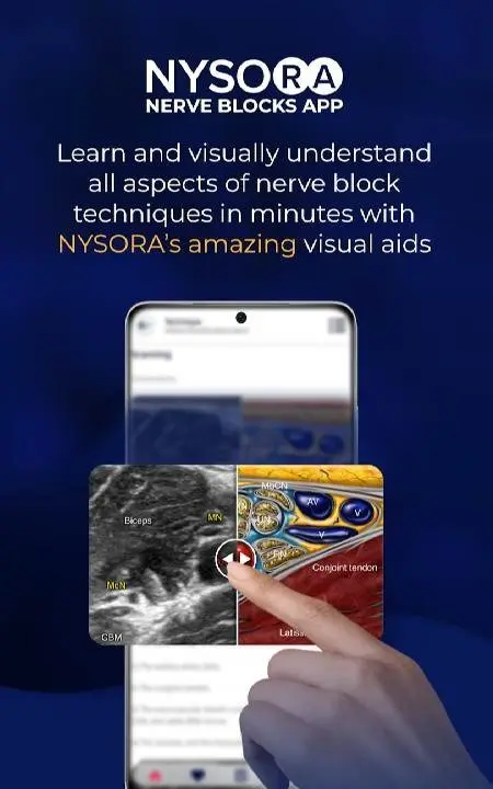 NYSORA Nerve Blocks - скриншот 2